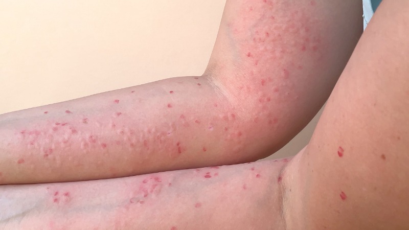 éruption cutanée variole du singe mpox